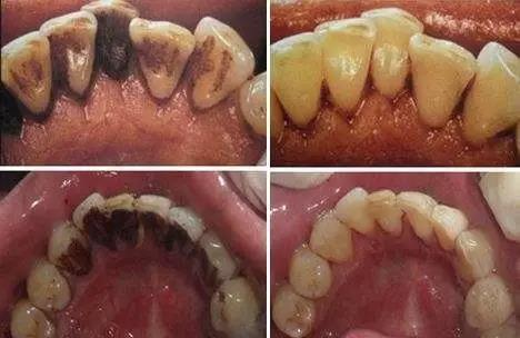 牙结石清洁前后对比图