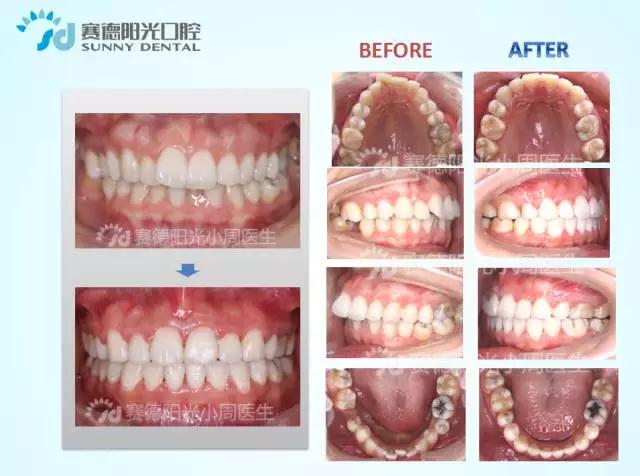 赛德阳光正畸医生周绍楠正畸案例前后对比图