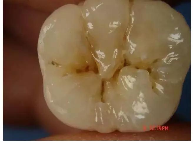 儿牙专家鲁莉英解读窝沟封闭和涂氟 赛德阳光口腔 北大口腔