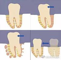 牙齿移动伴随着牙根周围组织的改建