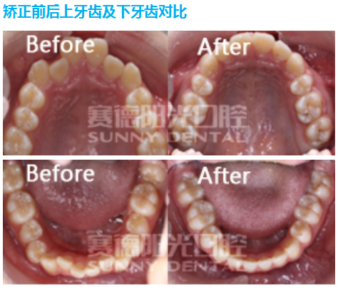 矫正牙齿前后对比照片