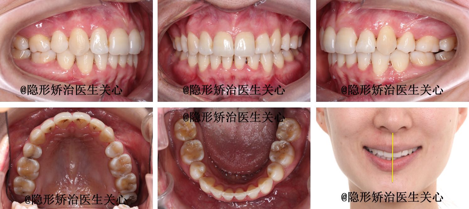 牙齿矫正正畸隐形矫治前后对比图