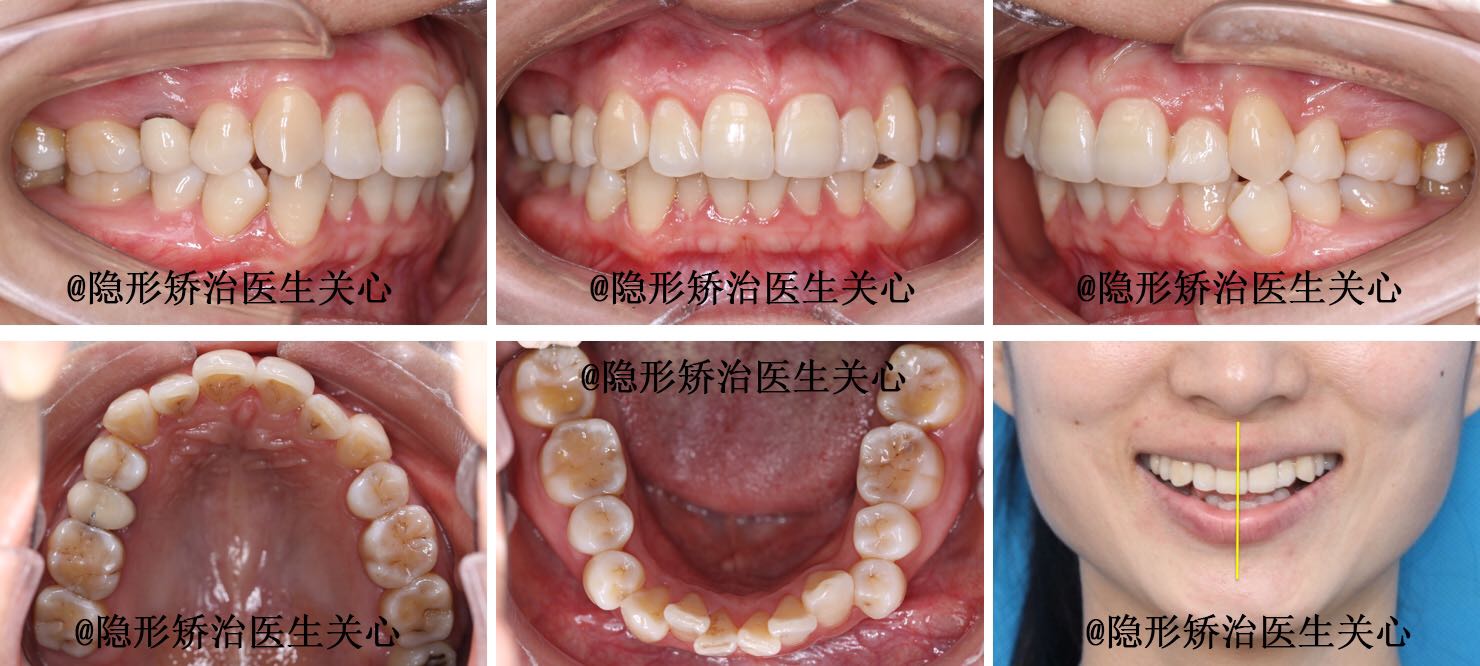 牙齿隐形矫治前后对比图