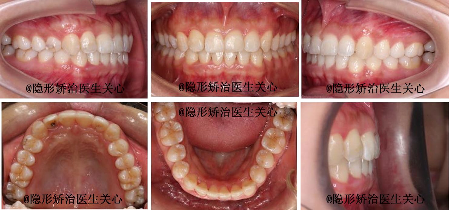 牙齿不齐隐形矫治前后对比图