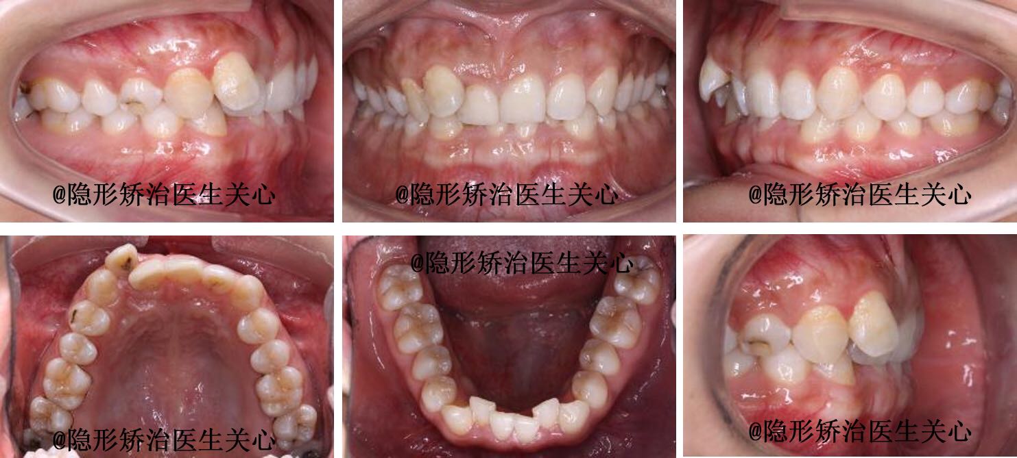 牙齿不齐隐形矫治正畸前后对比图