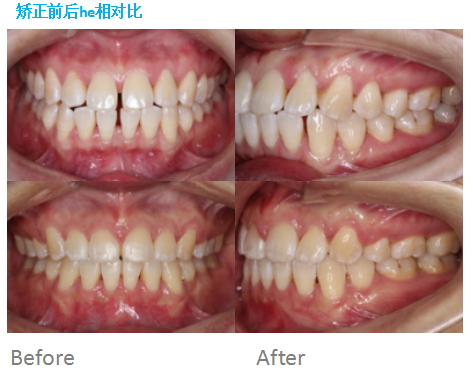 嘴突牙齿稀疏牙齿矫正前后对比图