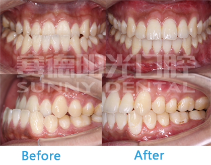 地包天牙齿矫正前后对比图