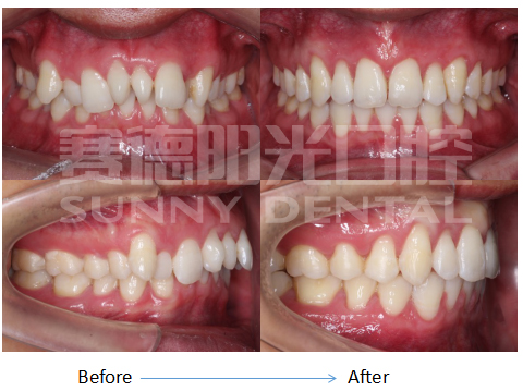 门列拥挤牙齿矫正前后对比图