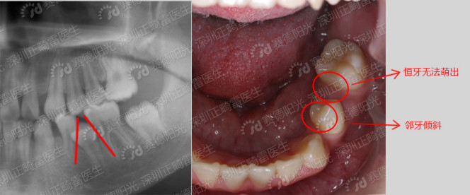 邻牙向缺牙处倾斜，导致缺隙处恒牙萌出受阻.jpg
