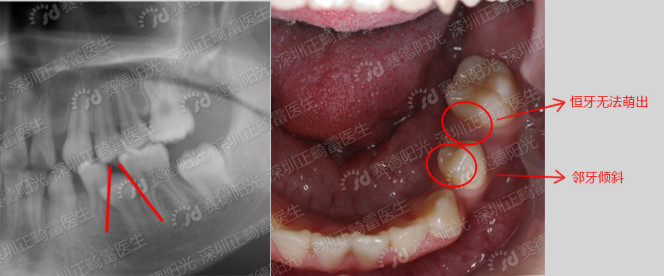 门牙恒牙异位萌出图图片