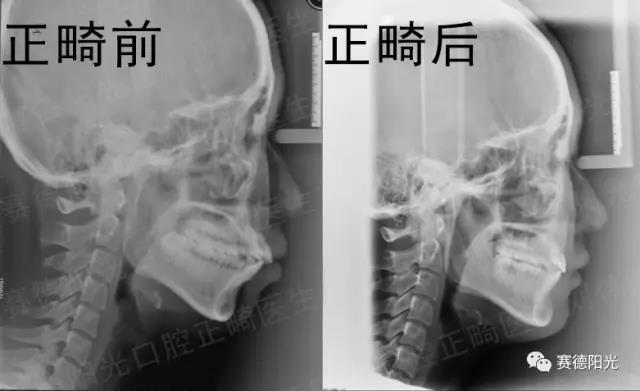 龅牙矫正 正畸牙齿对比 龅牙矫正 正畸牙齿对比