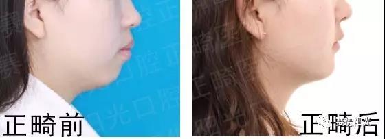 龅牙矫正 正畸前后对比图 龅牙矫正 正畸前后对比图