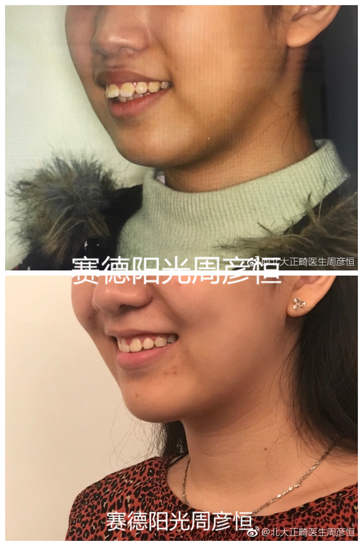 龅牙骨性前突正畸前后对比图