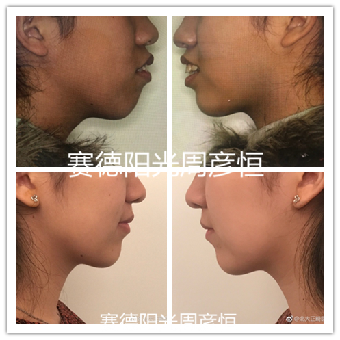 龅牙骨性前突正畸前后对比图
