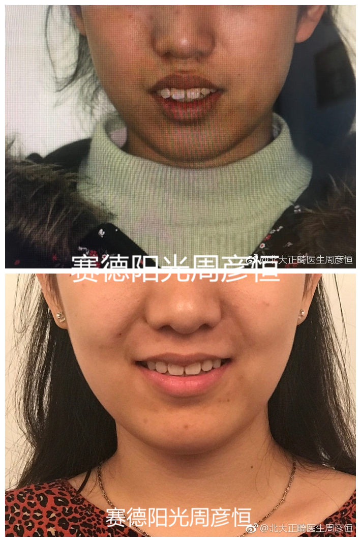 龅牙骨性前突正畸前后对比图
