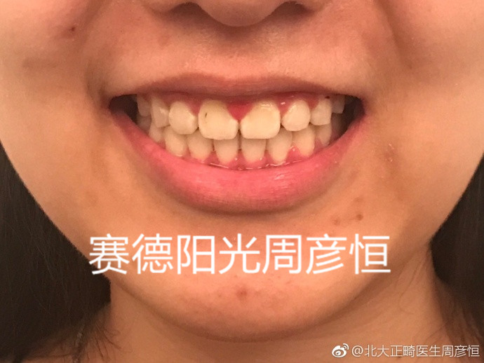 龅牙骨性前突正畸后图片