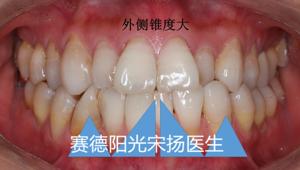 赛德阳光口腔宋扬医生牙齿黑三角科普图片