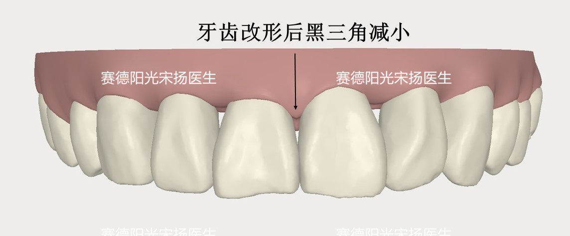 赛德阳光口腔宋扬医生牙齿黑三角科普图片