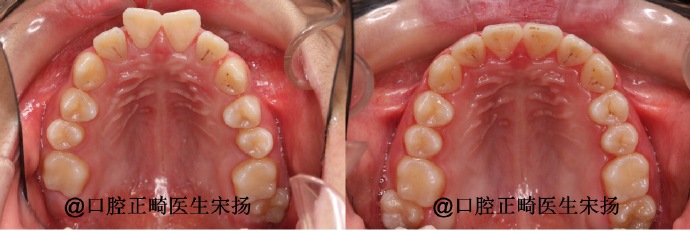 赛德阳光宋扬大夫正畸案例前后对比图