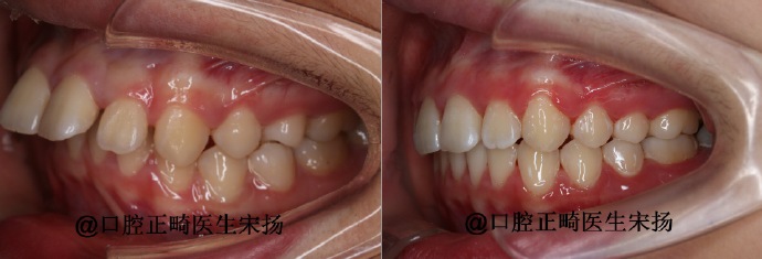 赛德阳光宋扬大夫正畸案例前后对比图