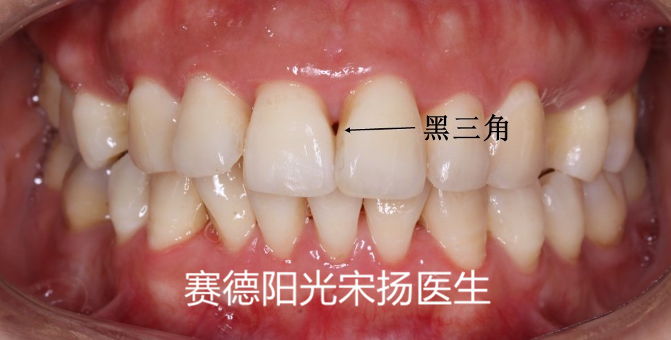 赛德阳光口腔宋扬医生牙齿黑三角科普图片