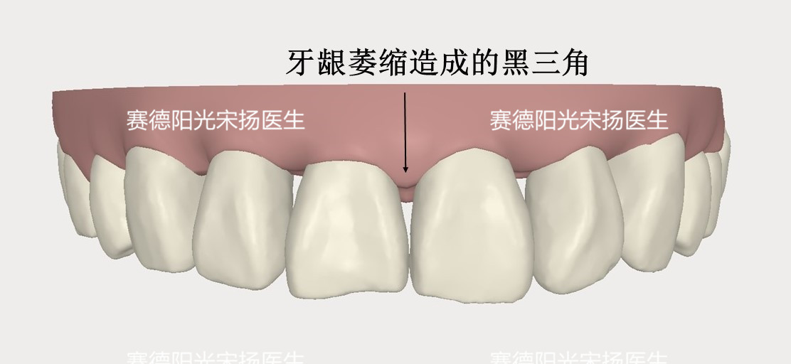 赛德阳光口腔宋扬医生牙齿黑三角科普图片