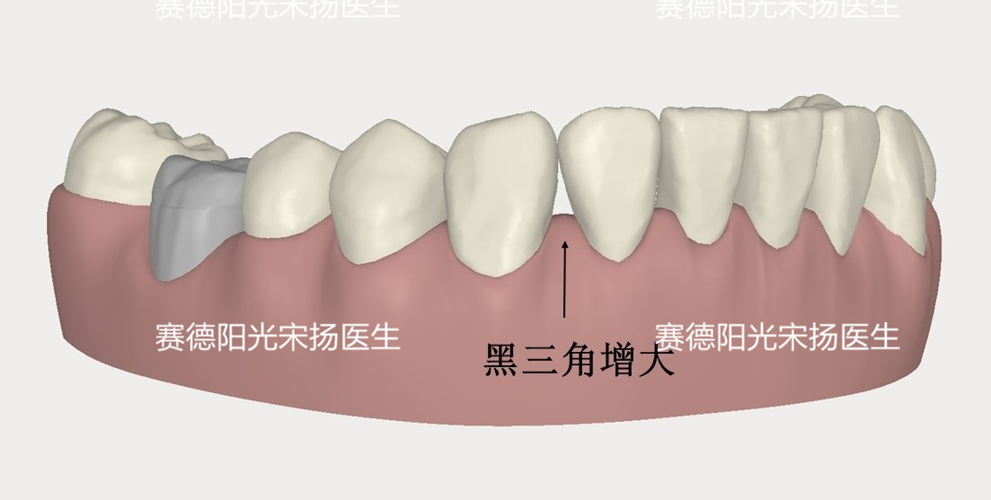 赛德阳光口腔宋扬医生牙齿黑三角科普图片