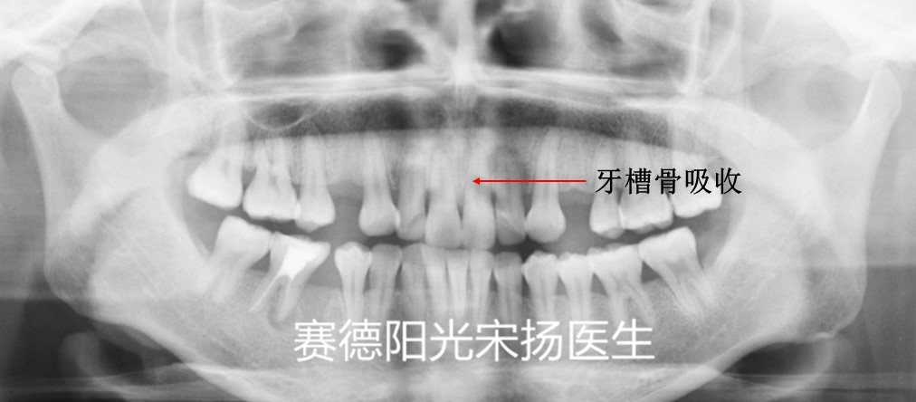 赛德阳光口腔宋扬医生牙齿黑三角科普图片