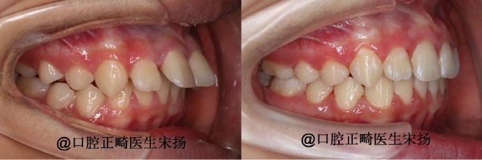 赛德阳光宋扬大夫正畸案例前后对比图