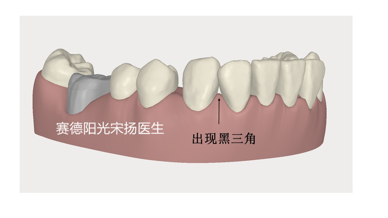 赛德阳光口腔宋扬医生牙齿黑三角科普图片