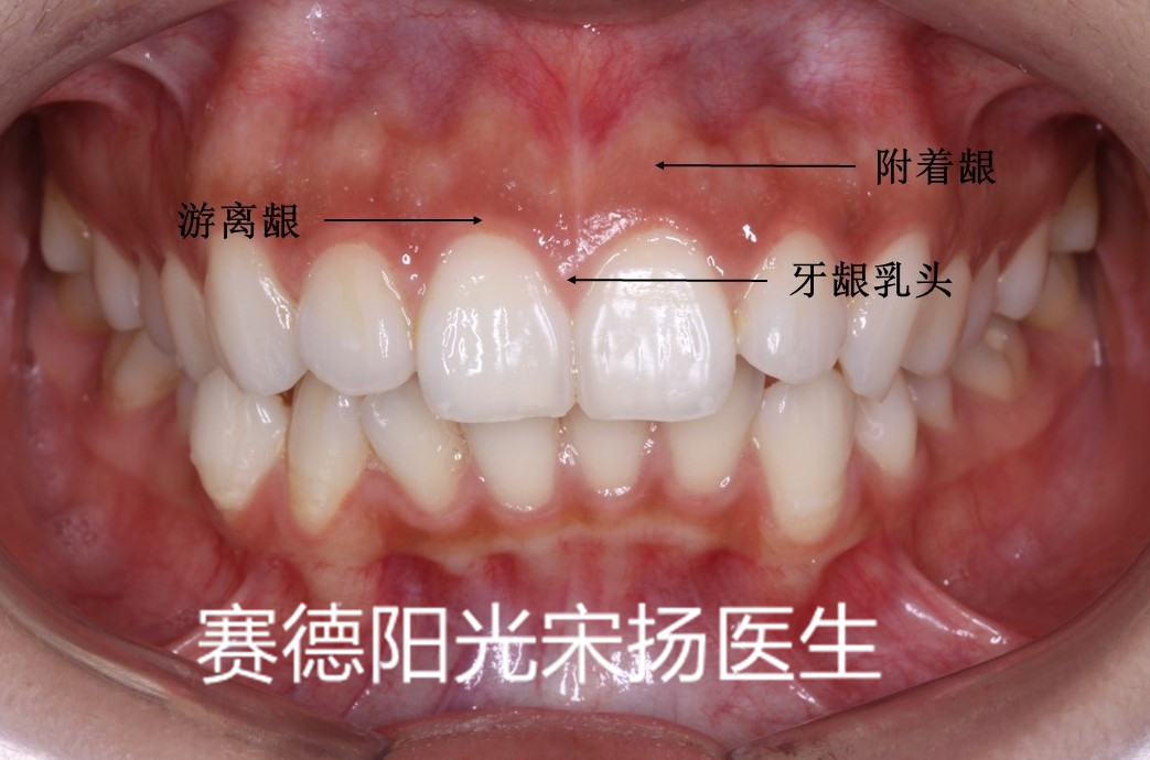 赛德阳光口腔宋扬医生牙齿黑三角科普图片