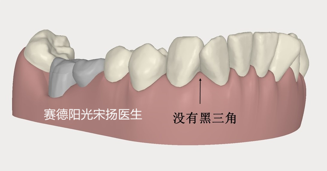 赛德阳光口腔宋扬医生牙齿黑三角科普图片