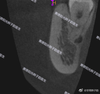 赛德阳光韩子韵医生拔牙案例