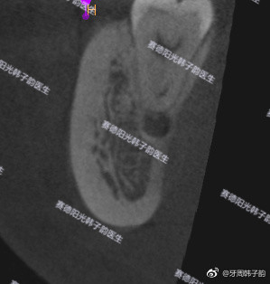 赛德阳光韩子韵医生拔牙案例