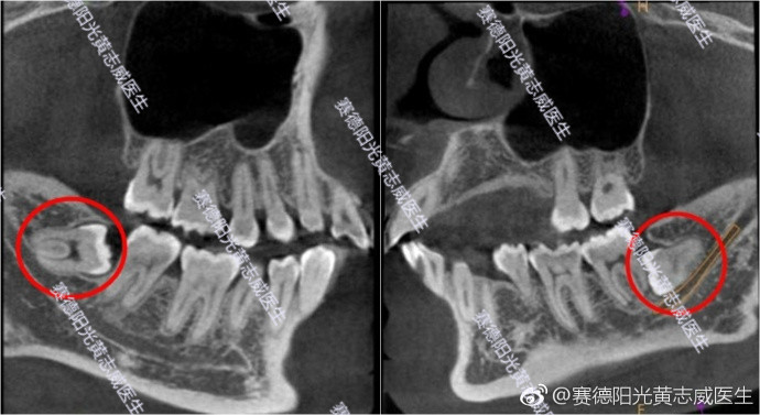 赛德阳光黄志威医生高难度拔牙病例