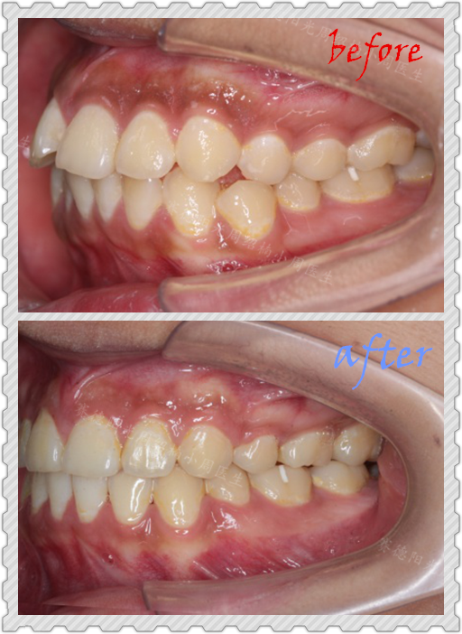 赛德阳光小周医生周绍楠牙齿矫正前后对比图