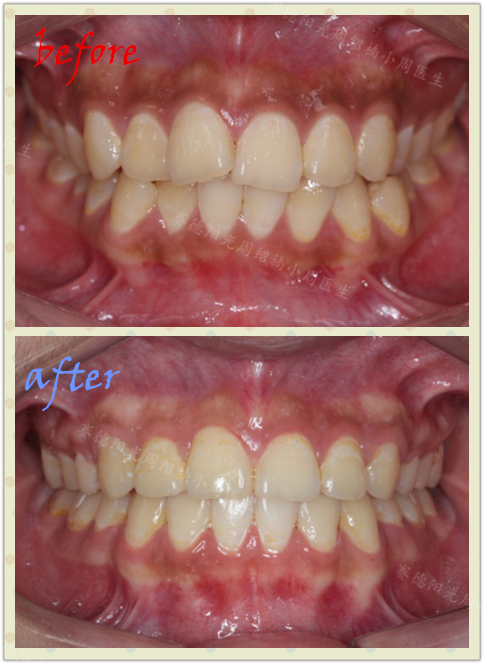 赛德阳光小周医生周绍楠牙齿矫正前后对比图