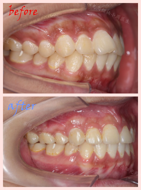 赛德阳光小周医生周绍楠牙齿矫正前后对比图