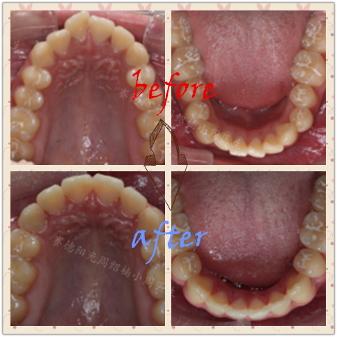 赛德阳光小周医生周绍楠牙齿矫正前后对比图