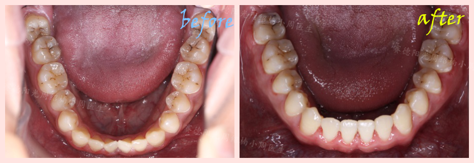 赛德阳光周绍楠小周医生正畸案例前后对比图.png