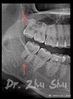 赛德阳光朱姝医生智齿案例图