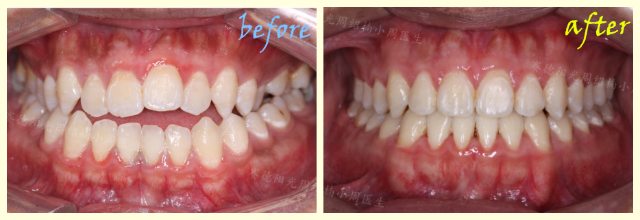 赛德阳光周绍楠小周医生正畸案例前后对比图.png
