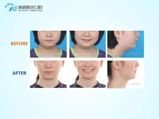 赛德阳光周绍楠小周医生正畸案例前后对比图.jpg