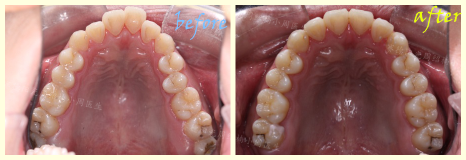 赛德阳光周绍楠小周医生正畸案例前后对比图.png