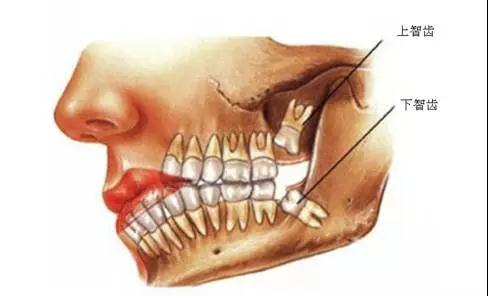 智齿示意图 赛德阳光口腔