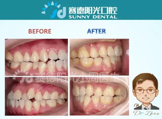 赛德阳光口腔正畸医生周绍楠案例前后对比图 赛德阳光口腔正畸医生周绍楠案例前后对比图