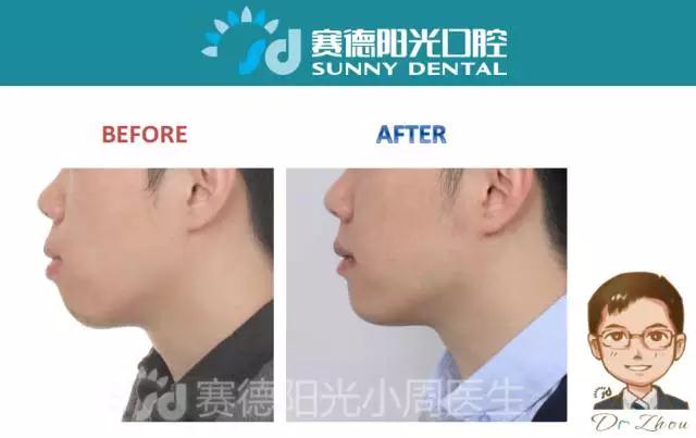 赛德阳光口腔正畸医生周绍楠案例前后对比图 赛德阳光口腔正畸医生周绍楠案例前后对比图