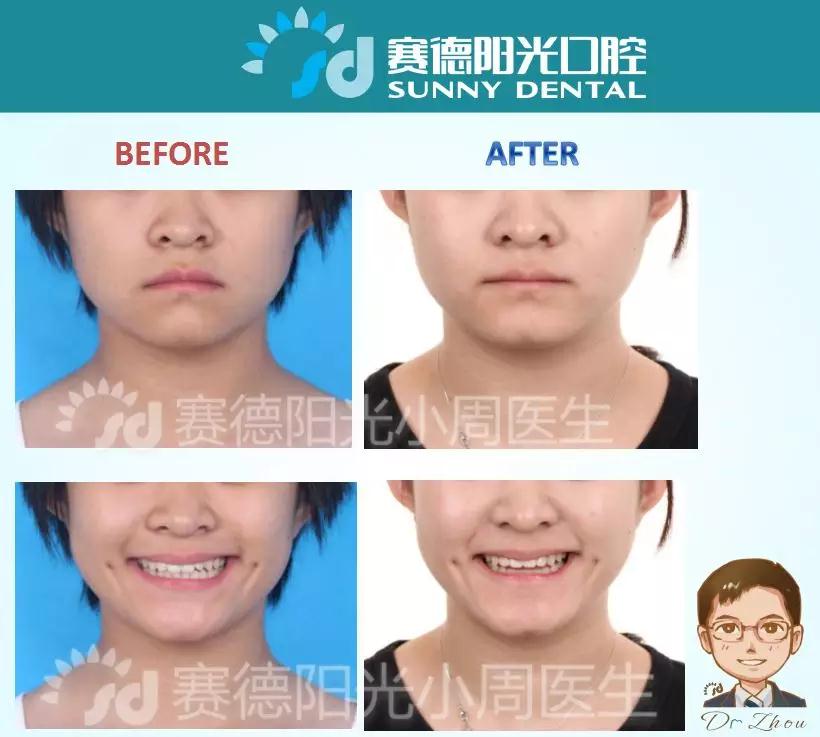 深圳牙医 北大口腔正畸学博士 赛德阳光口腔小周医生 正畸医生周绍楠 正畸案例前后对比图 深圳牙医 北大口腔正畸学博士 赛德阳光口腔小周医生 正畸医生周绍楠 正畸案例前后对比图