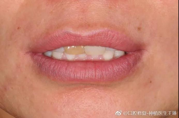 赛德阳光口腔 王琳医生 超薄贴面不磨牙 牙齿修复美容