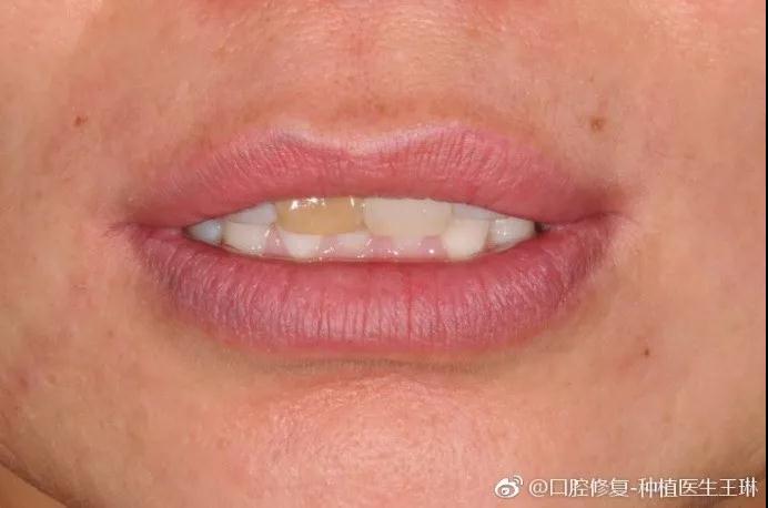 赛德阳光口腔 王琳医生 超薄贴面不磨牙 牙齿修复美容 赛德阳光口腔 王琳医生 超薄贴面不磨牙 牙齿修复美容